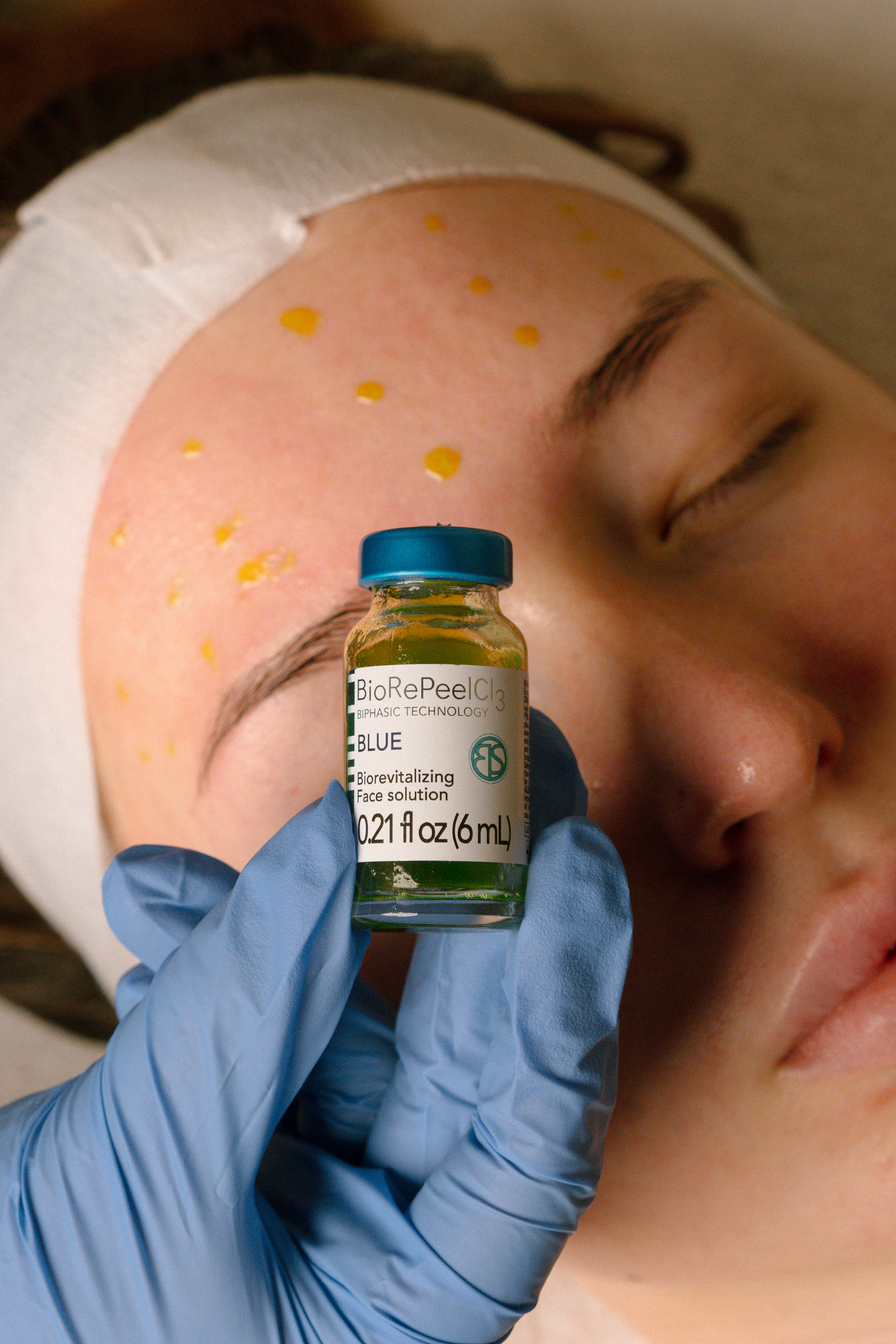 BioRePeel treatment at Skin Healthy Miami